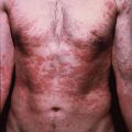 Паразитолог глисты аскариды пирантел острицы декарис лямблии фотография